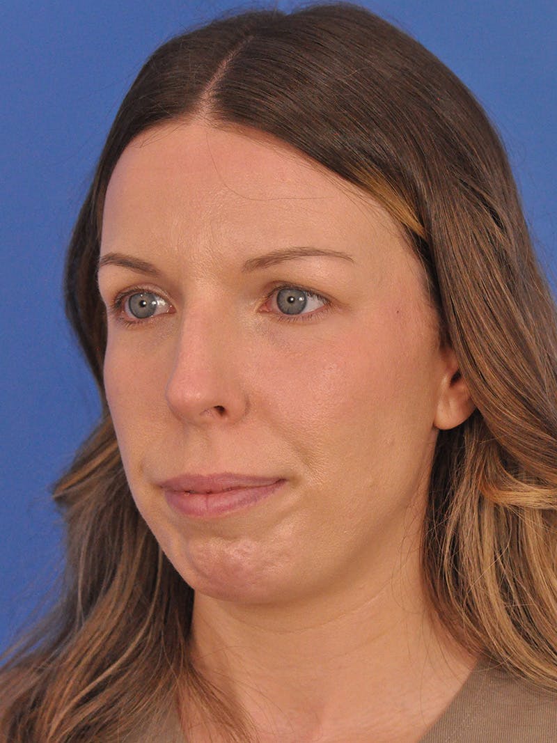 Rhinoplasty Before & After Gallery - Patient 391905 - Image 7