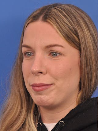 Rhinoplasty Before & After Gallery - Patient 391905 - Image 8