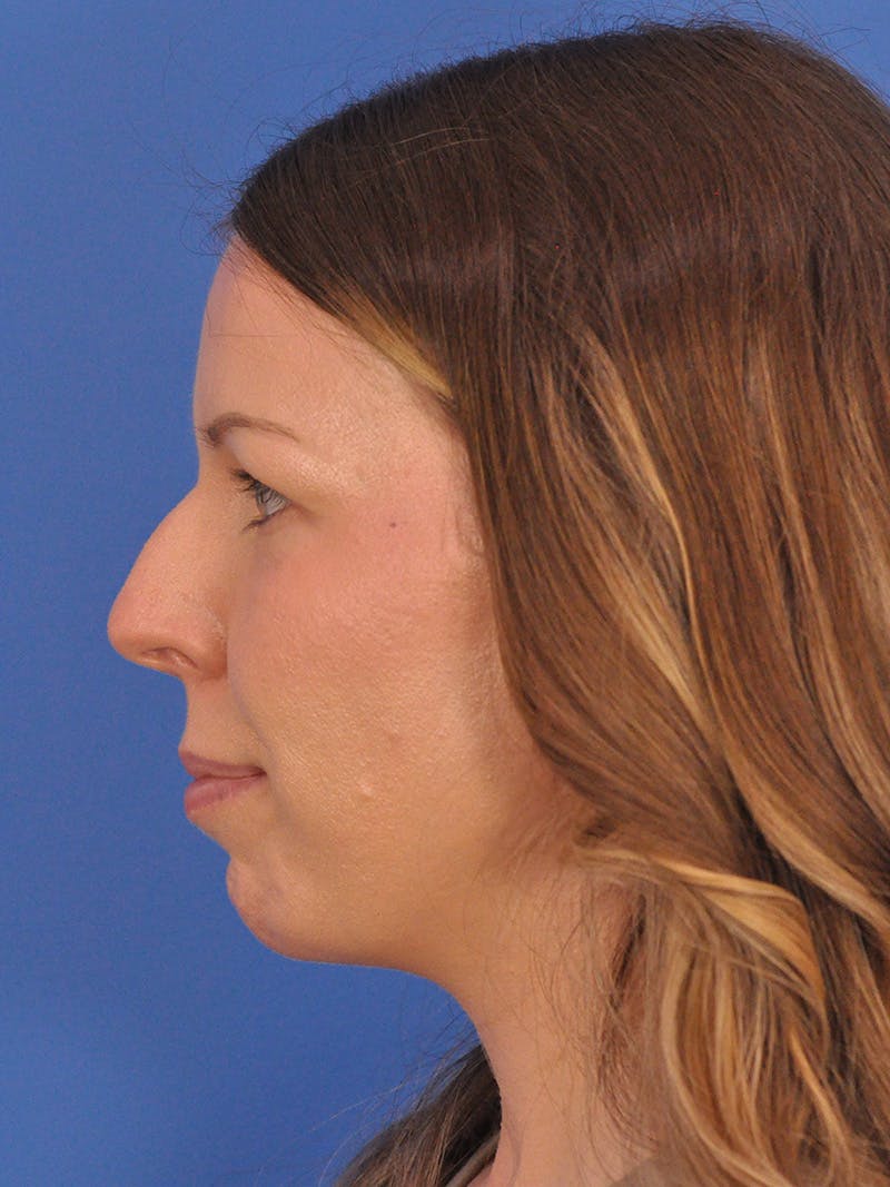 Rhinoplasty Before & After Gallery - Patient 391905 - Image 9