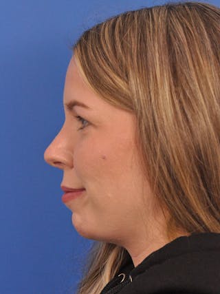 Rhinoplasty Before & After Gallery - Patient 391905 - Image 10