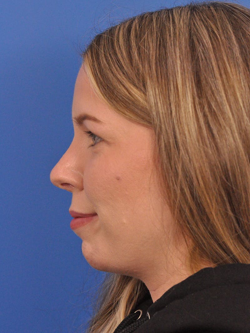 Rhinoplasty Before & After Gallery - Patient 391905 - Image 10