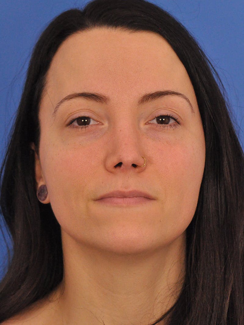 Rhinoplasty Before & After Gallery - Patient 362933 - Image 6