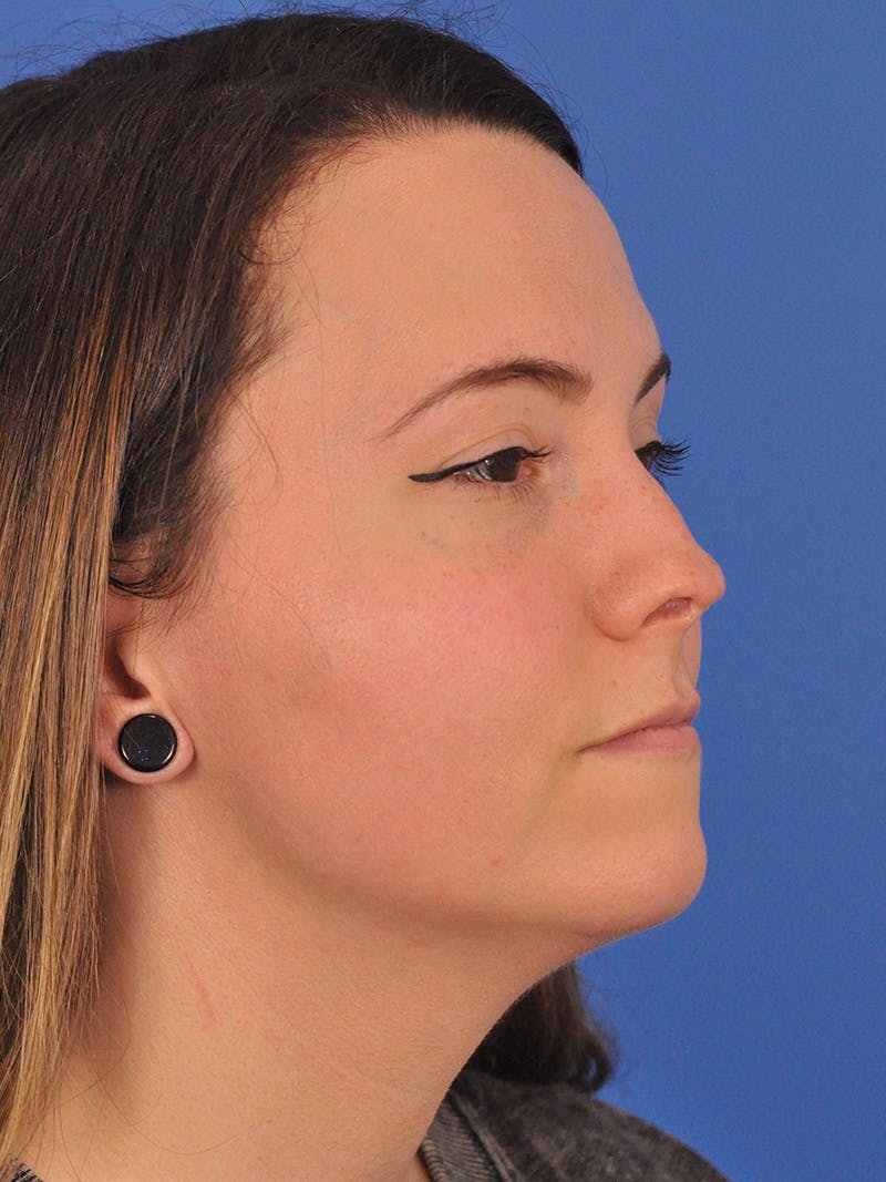 Rhinoplasty Before & After Gallery - Patient 362933 - Image 3