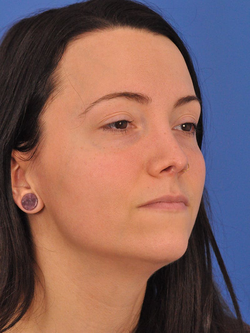 Rhinoplasty Before & After Gallery - Patient 362933 - Image 4
