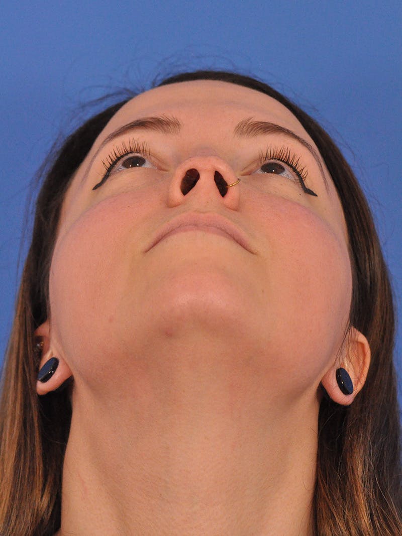 Rhinoplasty Before & After Gallery - Patient 362933 - Image 11