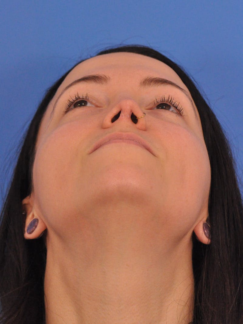 Rhinoplasty Before & After Gallery - Patient 362933 - Image 12
