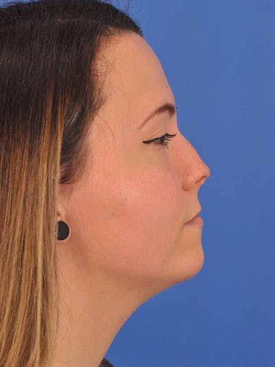 Rhinoplasty Before & After Gallery - Patient 362933 - Image 1