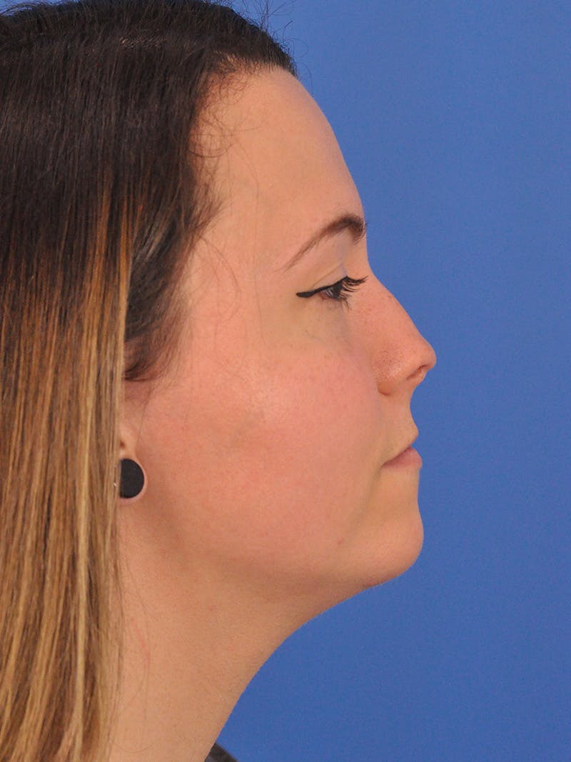 Rhinoplasty Before & After Gallery - Patient 362933 - Image 1