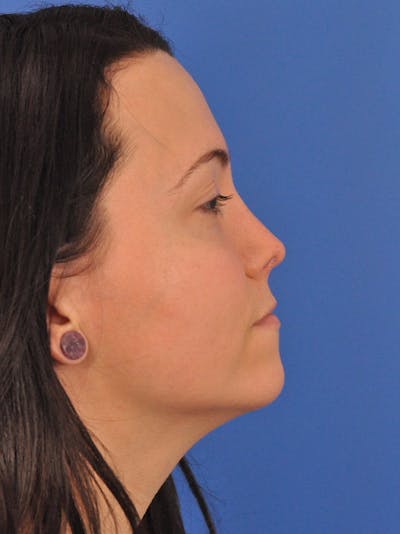Rhinoplasty Before & After Gallery - Patient 362933 - Image 2