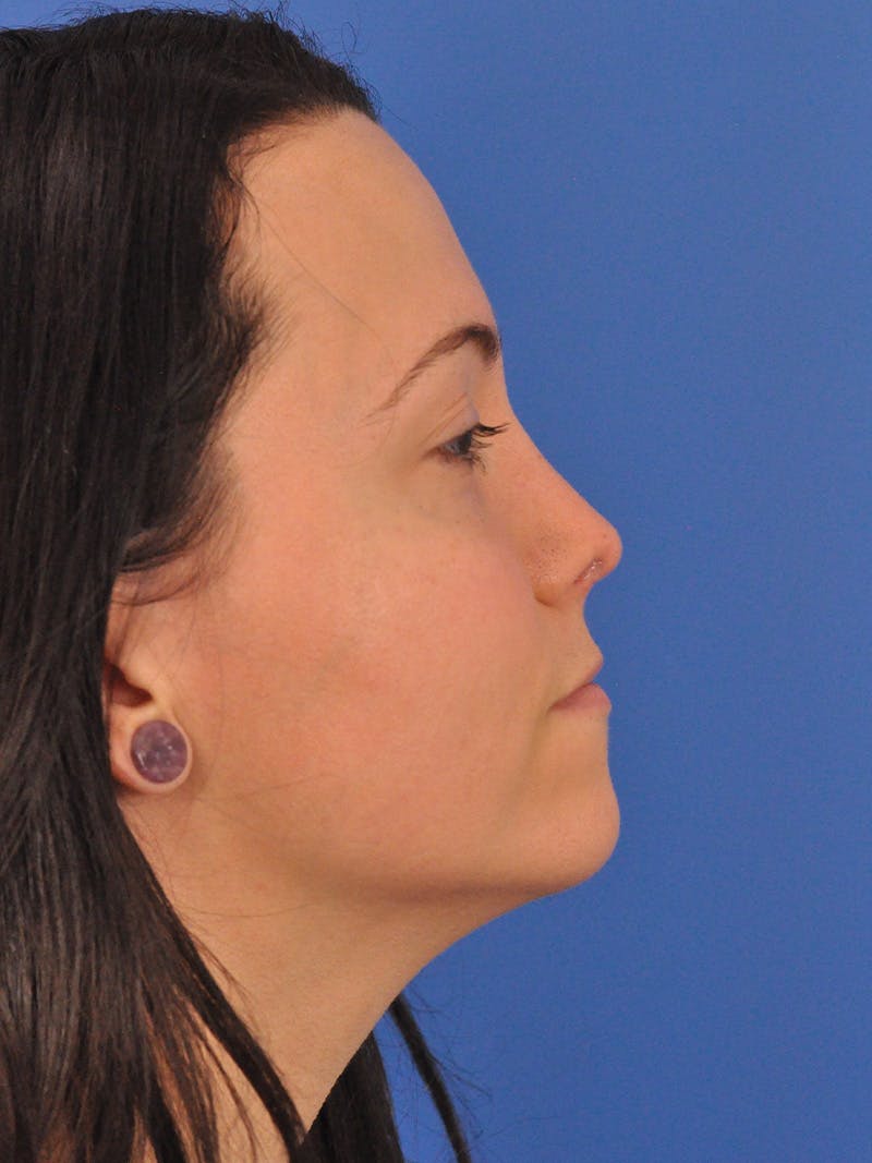 Rhinoplasty Before & After Gallery - Patient 362933 - Image 2