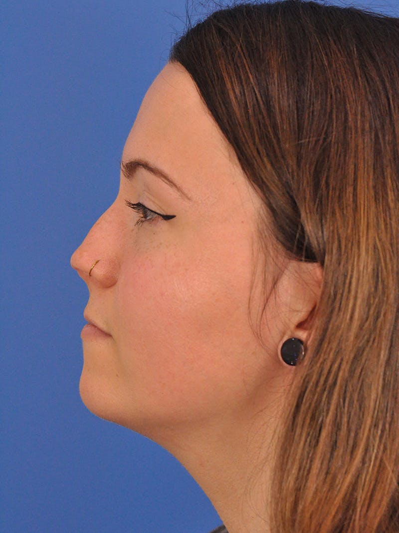 Rhinoplasty Before & After Gallery - Patient 362933 - Image 9