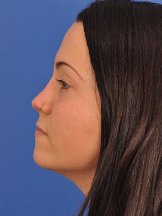 Rhinoplasty Before & After Gallery - Patient 362933 - Image 10
