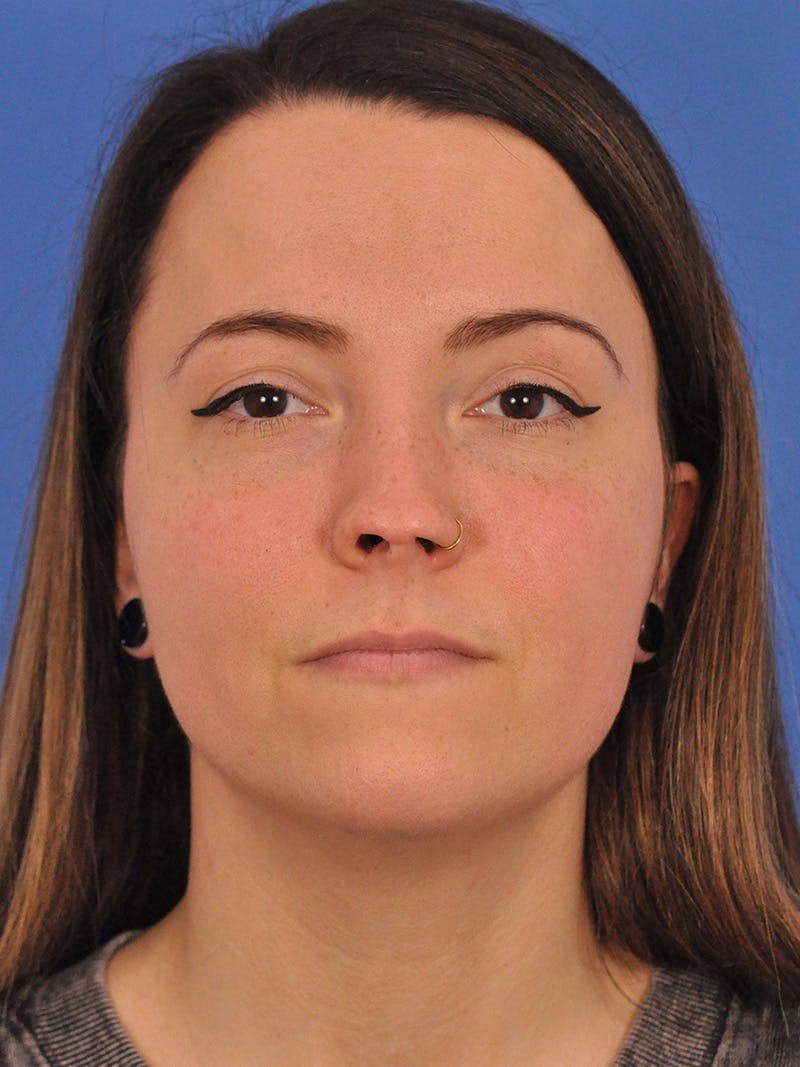 Rhinoplasty Before & After Gallery - Patient 362933 - Image 5