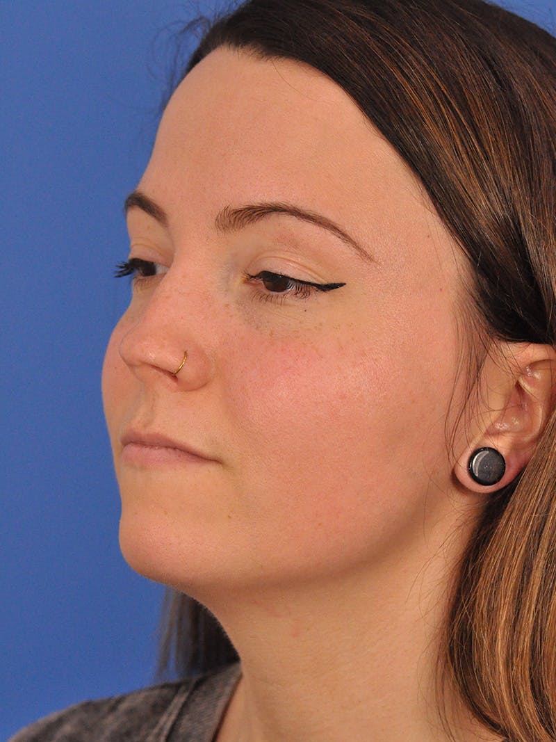 Rhinoplasty Before & After Gallery - Patient 362933 - Image 7