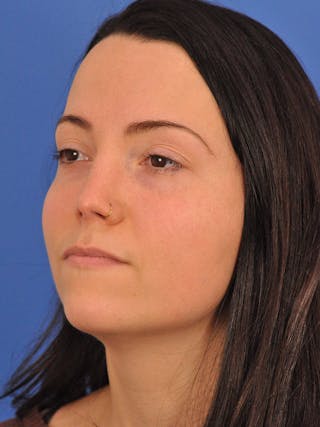 Rhinoplasty Before & After Gallery - Patient 362933 - Image 8