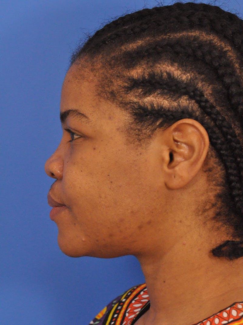 Rhinoplasty Before & After Gallery - Patient 159935 - Image 9