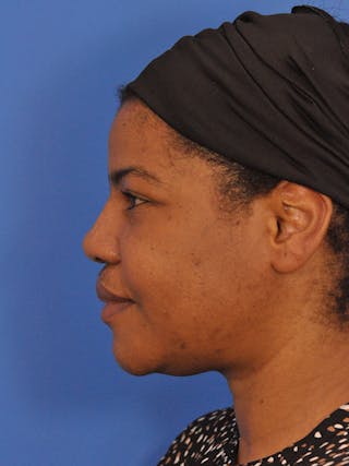 Rhinoplasty Before & After Gallery - Patient 159935 - Image 10