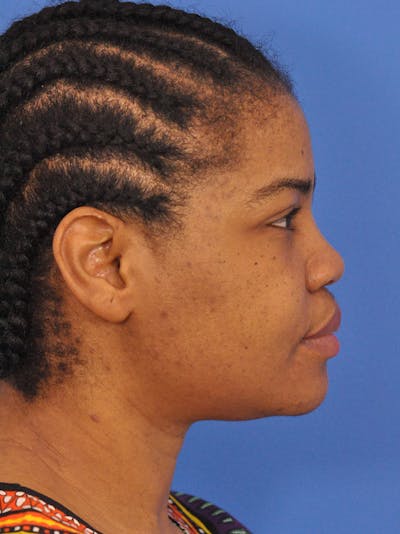 Rhinoplasty Before & After Gallery - Patient 159935 - Image 1