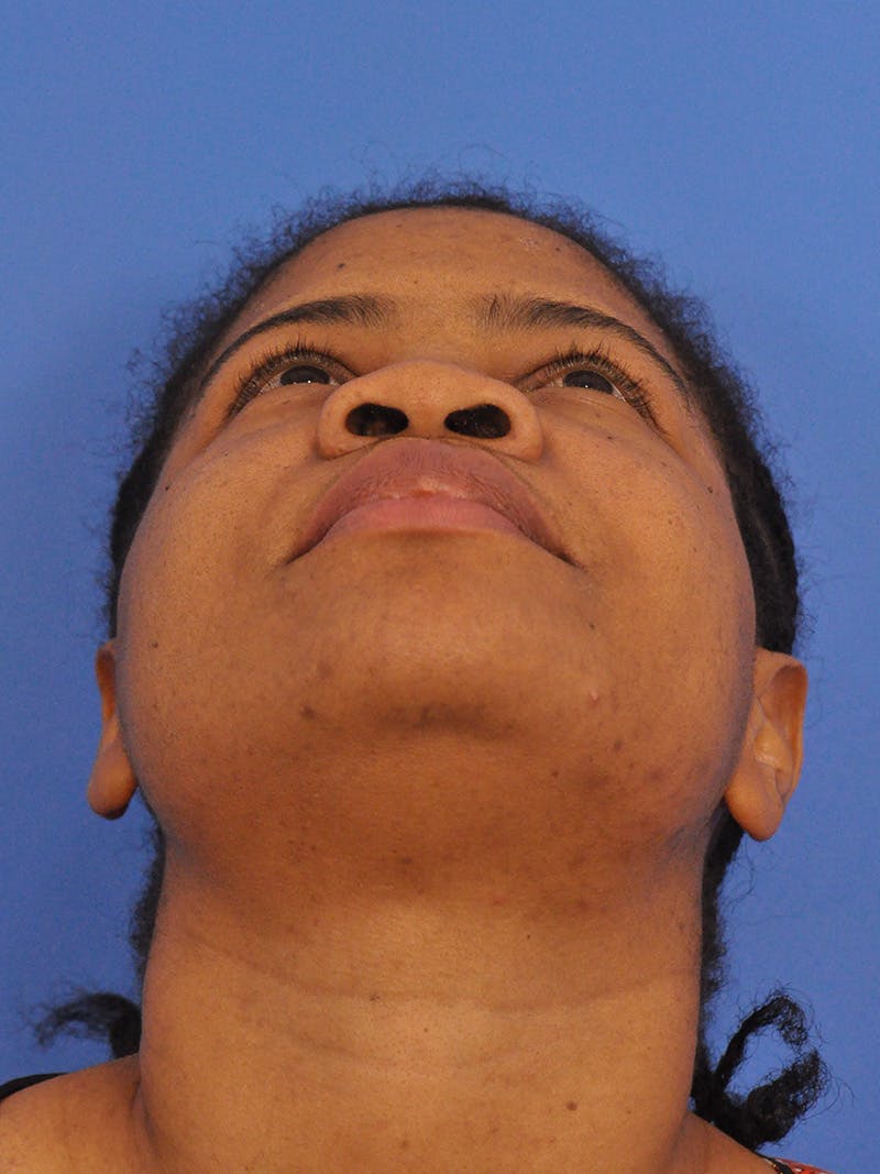Rhinoplasty Before & After Gallery - Patient 159935 - Image 11