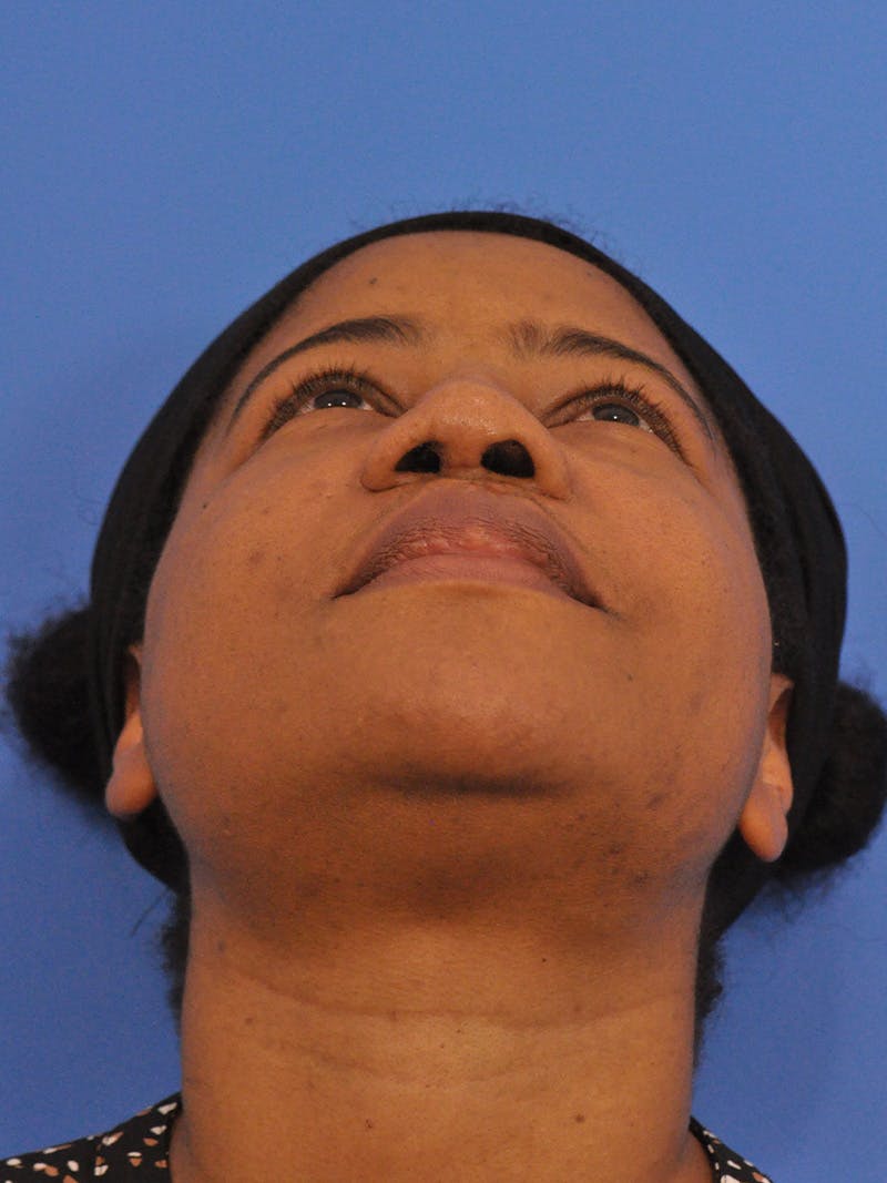 Rhinoplasty Before & After Gallery - Patient 159935 - Image 12