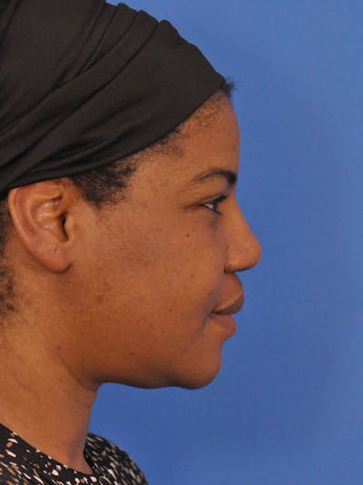 Rhinoplasty Before & After Gallery - Patient 159935 - Image 2