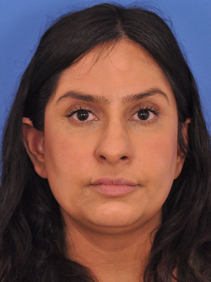 Rhinoplasty Before & After Gallery - Patient 401647 - Image 5
