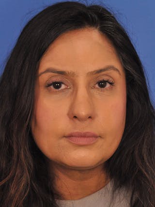 Rhinoplasty Before & After Gallery - Patient 401647 - Image 6