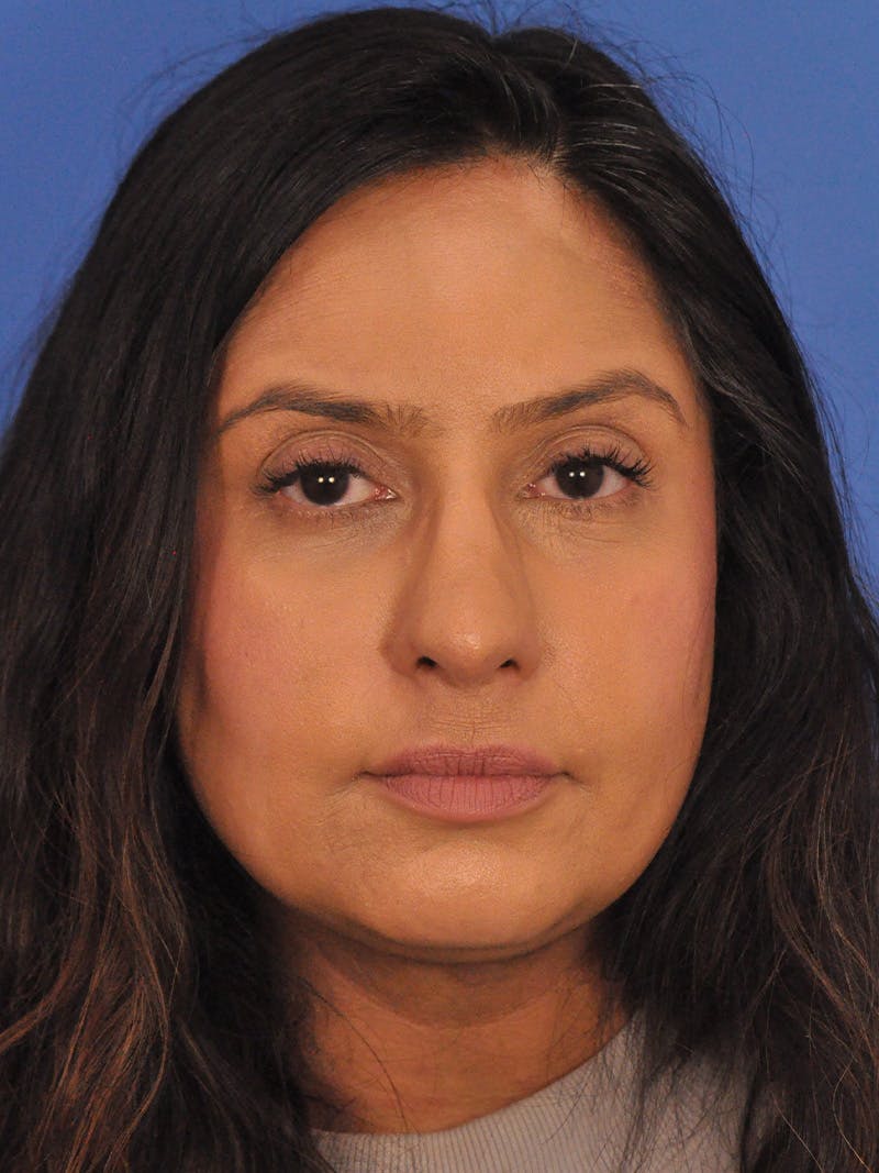 Rhinoplasty Before & After Gallery - Patient 401647 - Image 6