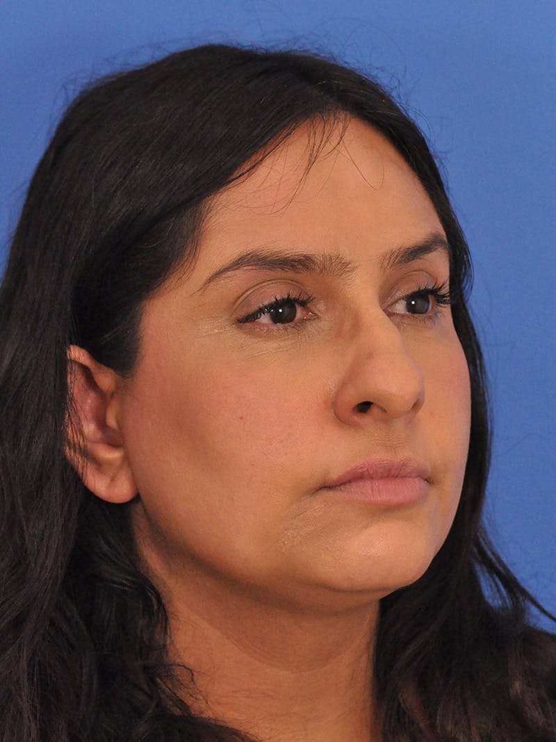 Rhinoplasty Before & After Gallery - Patient 401647 - Image 3