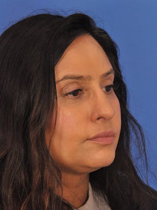 Rhinoplasty Before & After Gallery - Patient 401647 - Image 4