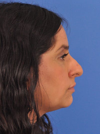 Rhinoplasty Before & After Gallery - Patient 401647 - Image 1