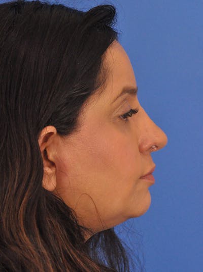 Rhinoplasty Before & After Gallery - Patient 401647 - Image 2