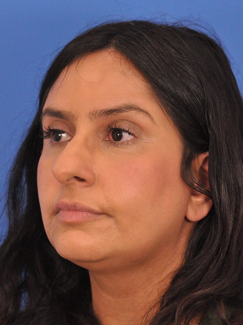 Rhinoplasty Before & After Gallery - Patient 401647 - Image 7
