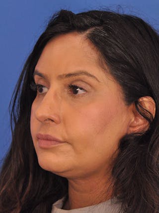 Rhinoplasty Before & After Gallery - Patient 401647 - Image 8