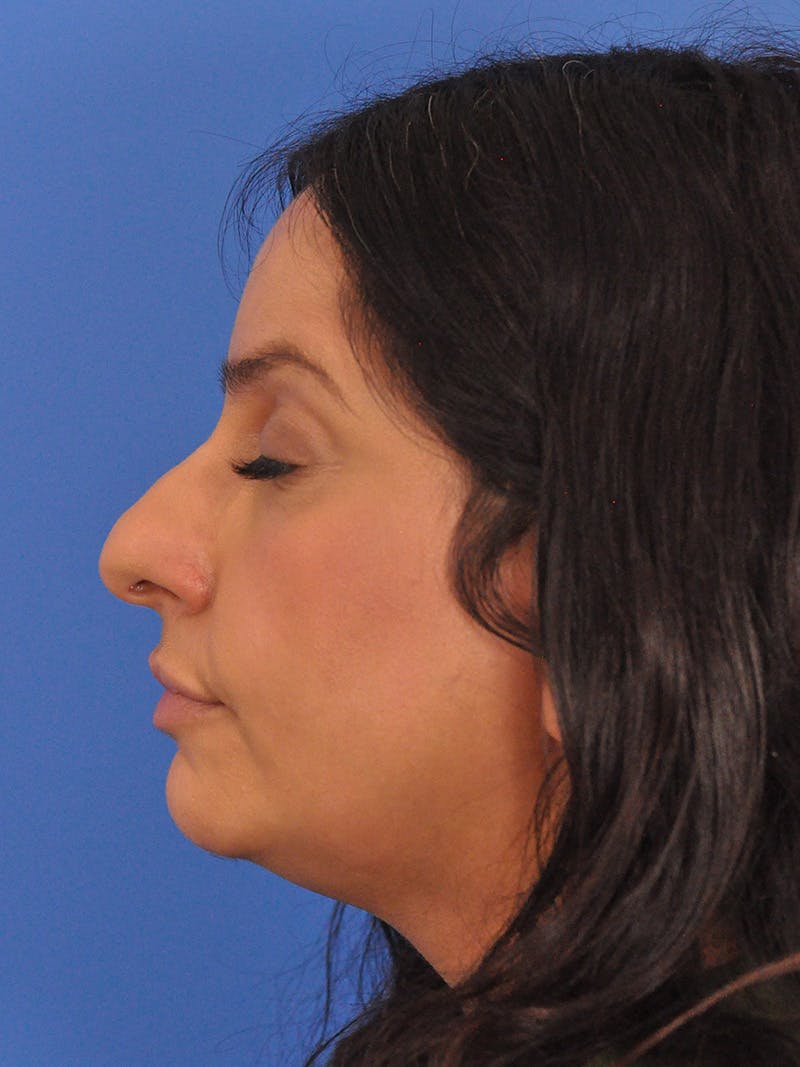 Rhinoplasty Before & After Gallery - Patient 401647 - Image 9