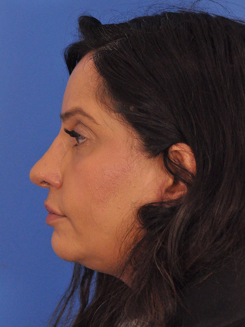 Rhinoplasty Before & After Gallery - Patient 401647 - Image 10