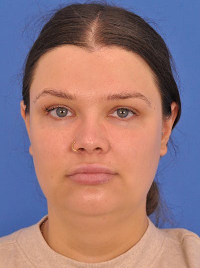 Brow Lift Before & After Gallery - Patient 207369 - Image 1