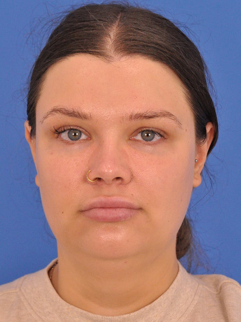 Neck Lift Before & After Gallery - Patient 280254 - Image 5