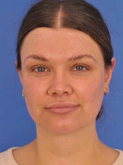 Buccal Fat Removal Before & After Gallery - Patient 354610 - Image 2