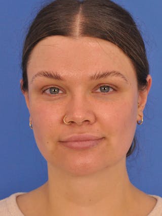 Neck Lift Before & After Gallery - Patient 280254 - Image 6