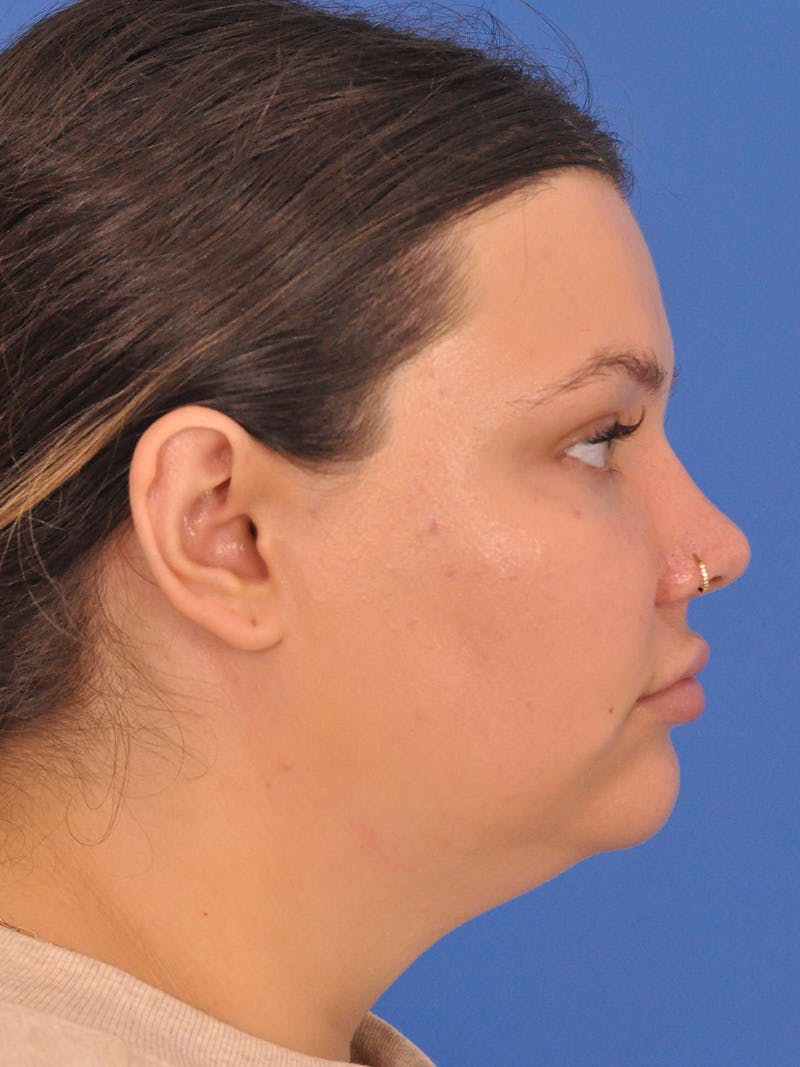 Neck Lift Before & After Gallery - Patient 280254 - Image 1