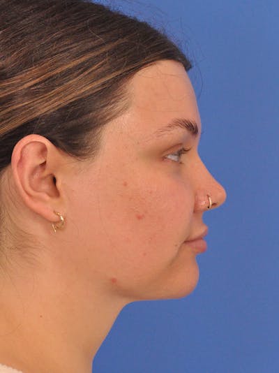 Neck Lift Before & After Gallery - Patient 280254 - Image 2