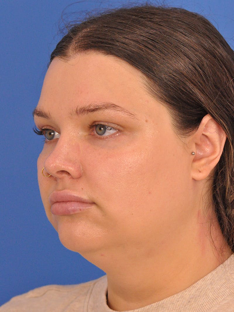 Neck Lift Before & After Gallery - Patient 280254 - Image 7