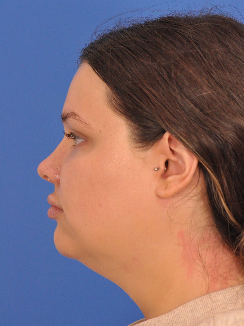 Neck Lift Before & After Gallery - Patient 280254 - Image 9
