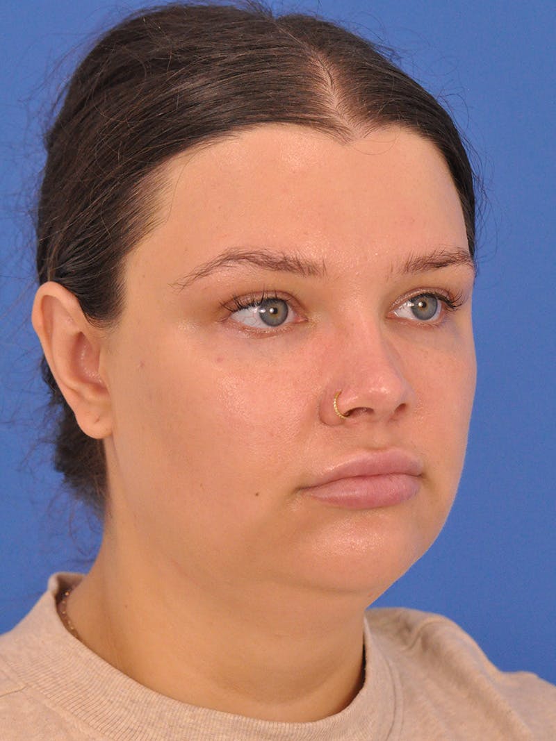 Neck Lift Before & After Gallery - Patient 280254 - Image 3