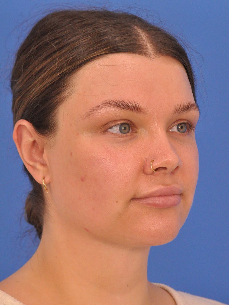 Neck Lift Before & After Gallery - Patient 280254 - Image 4