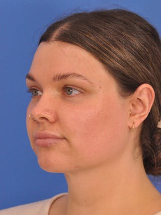 Neck Lift Before & After Gallery - Patient 280254 - Image 8