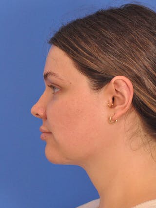 Neck Lift Before & After Gallery - Patient 280254 - Image 10