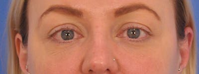 Blepharoplasty Before & After Gallery - Patient 414762 - Image 2