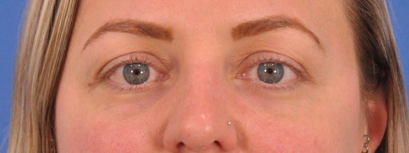 Blepharoplasty Before & After Gallery - Patient 414762 - Image 1
